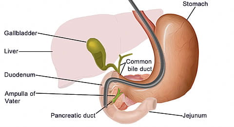 ERCP TREATMENT